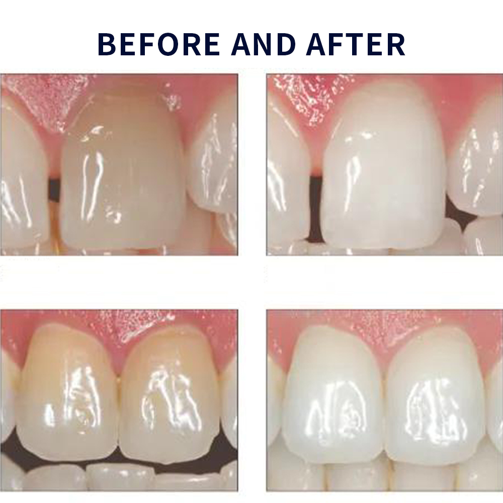 Opalescence Whitening 20% PF 2 - Teeth Whitening Near Me review and price