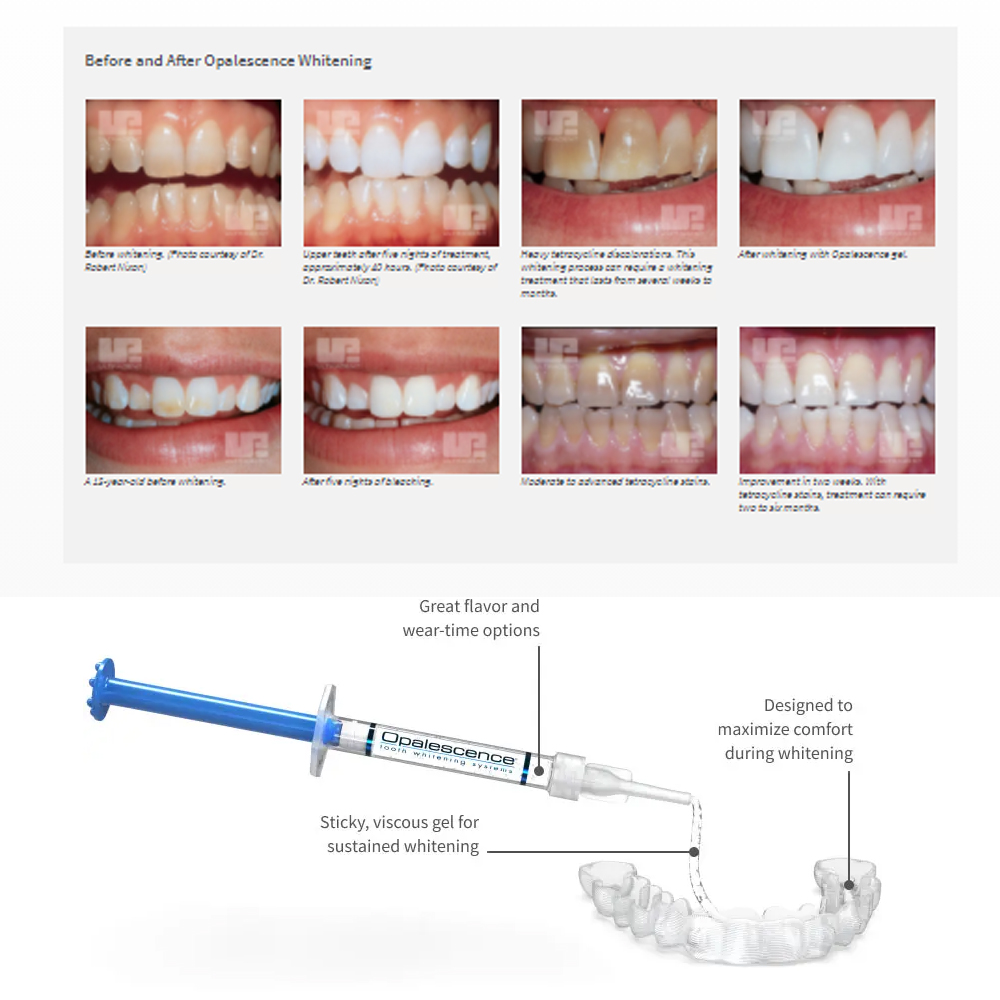 Opalescence Whitening 20% PF 2 - Teeth Whitening Near Me review and price